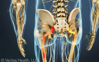 Sciatic Nerve Pain