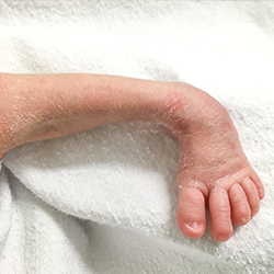 Clubfoot