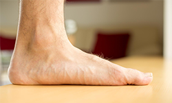 Flat Foot (Pes Planus)
