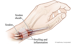 De Quervain’s Tendonosis