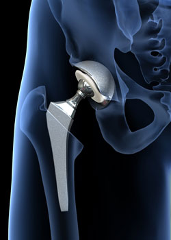 Total Hip Replacement