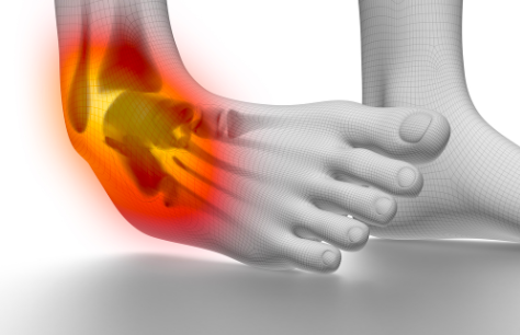 Broken Ankle or a Sprain: How do you Know?