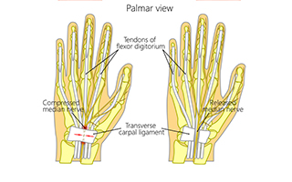 Treat Carpal Tunnel Syndrome at MidAmerica’s Palos Hills & Mokena Locations