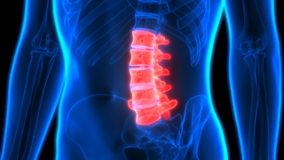 Spinal Stenosis