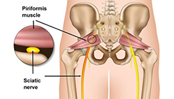 What Is Piriformis Syndrome? - MASS4D® Foot Orthotics