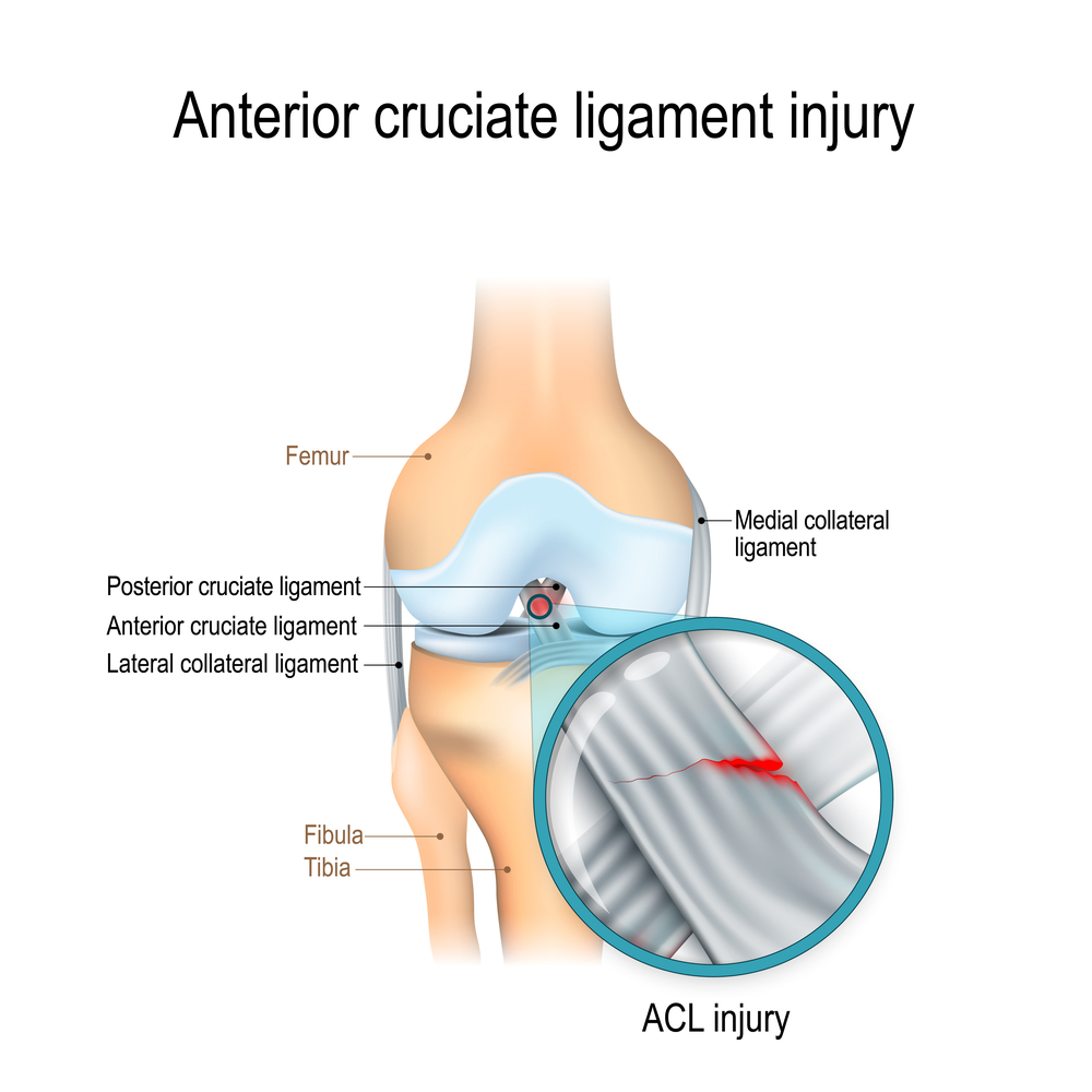 acl sprain