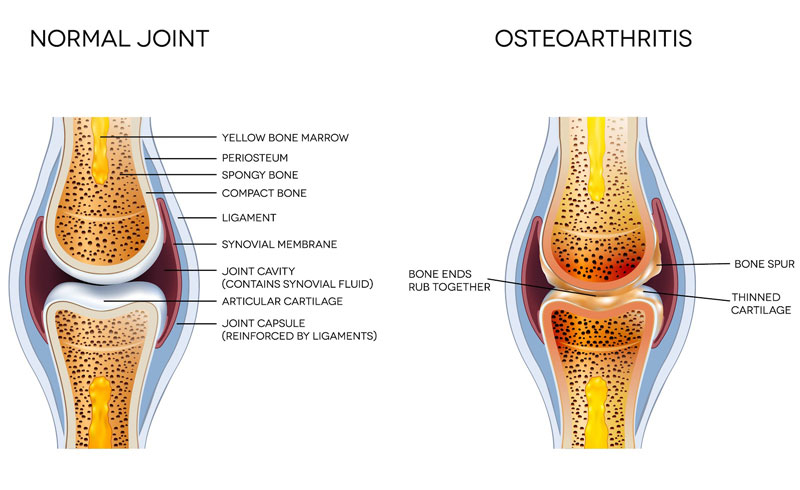 Graphic showing the difference between what a normal knee joint looks like versus a knee joint with osteoarthritis.