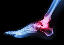 Foot and Ankle Fractures