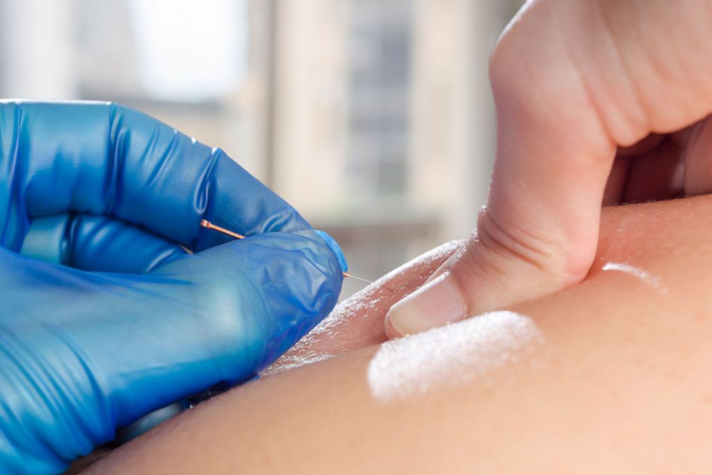 What is Dry Needling?  Preferred Physical Therapy