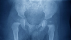 All About Hip Replacements, Available at MidAmerica's Palos Hills & Mokena  Locations